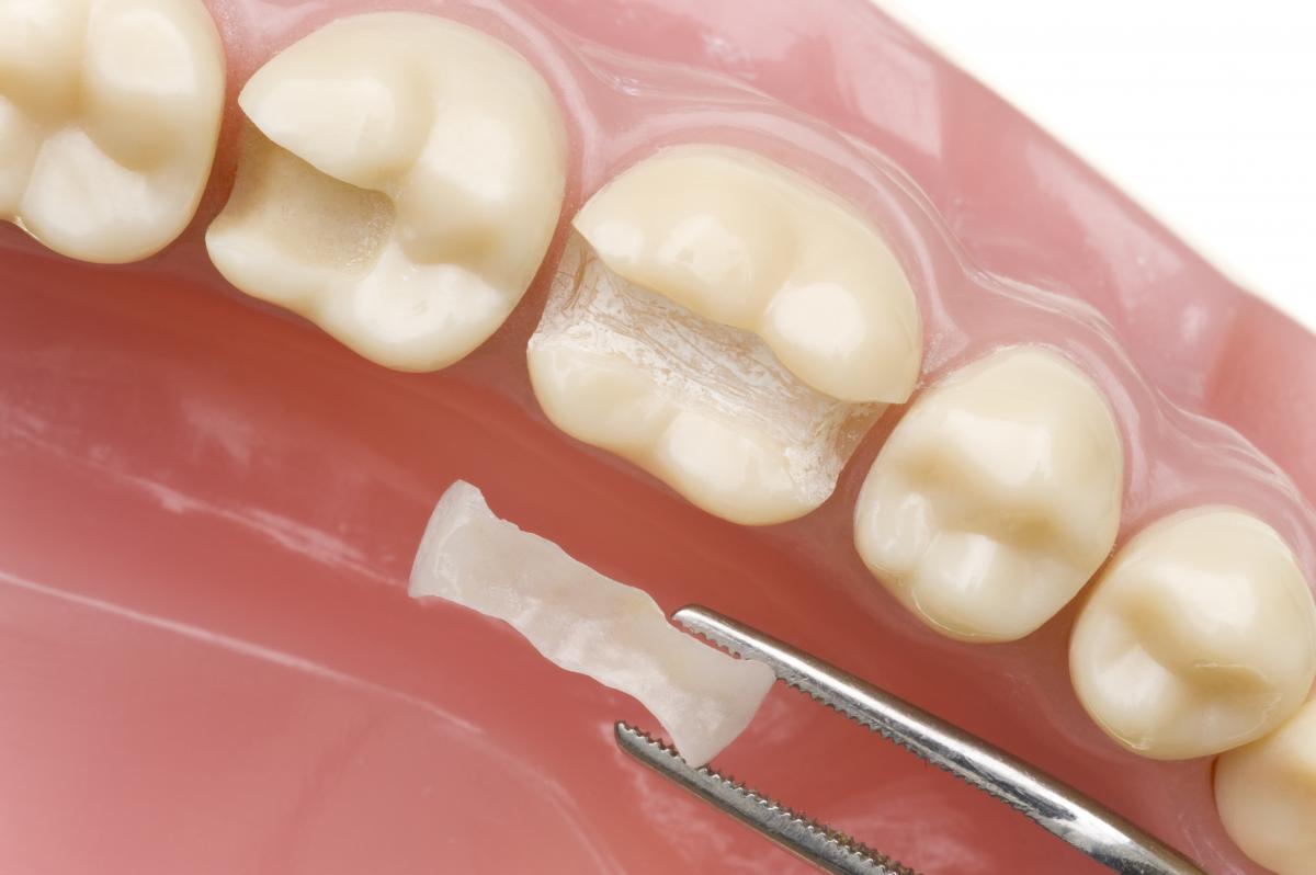Процесс восстановления зуба